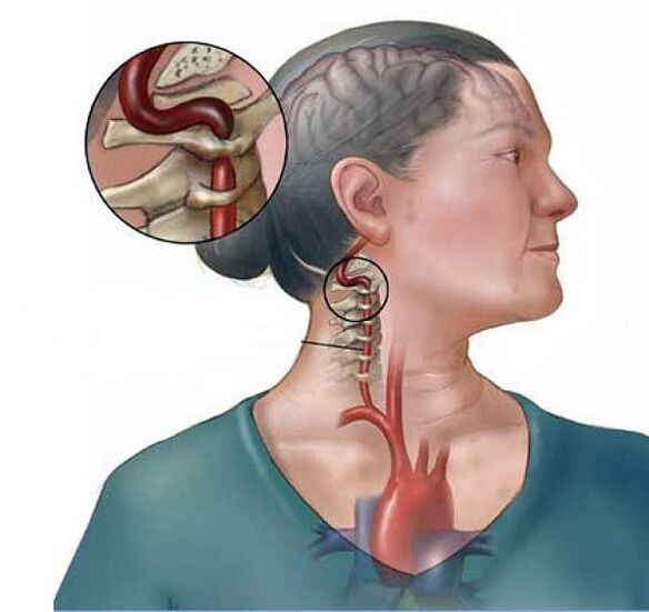синдроми ҳавопаймои баландтар бо остеохондрозҳои бачадон